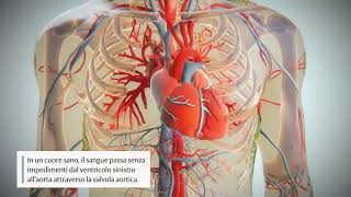 Come progredisce la stenosi aortica [upl. by Meletius]