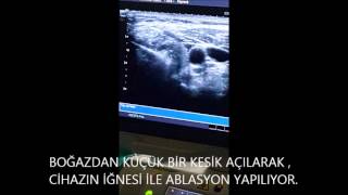 ANTALYA EĞİTİM VE ARAŞTIRMA HASTANESİ TİROİD NODÜL ABLASYONU [upl. by Brittaney706]