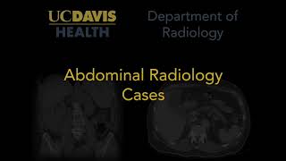 Hepatic steatosis MRI [upl. by Rawde]