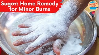 Sugar A Home Remedy for Minor Burn Relief  My Experience [upl. by Jammal]