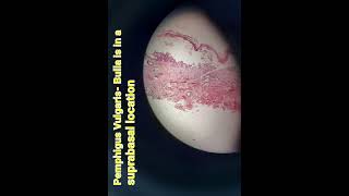 Pemphigus vulgarisdermapathskinbullous diseaseHand Ehistologypathologymedical [upl. by Ecirtael]