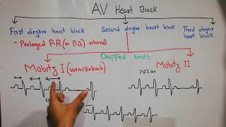 CVS physiology 49Second degree heart blockMobitz type 1Wenckebachamp Mobitz type 2 Dropped beats [upl. by Chemar206]