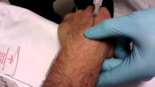 Ganglion cyst Aspirationremoval done right [upl. by Kapor642]