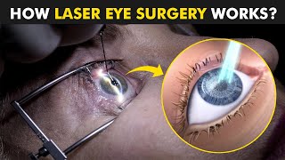 How Laser Eye Surgery Lasik is Performed  Lasik plus Miami [upl. by Dhu]