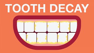 What causes tooth decay [upl. by Aiam]