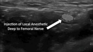 Ultrasound Guided Femoral Nerve Block [upl. by Alamaj]