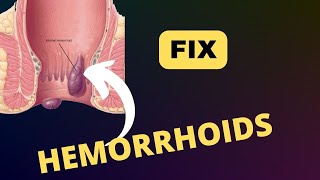 Hemorrhoids  how they form and how to fix amp prevent them [upl. by Azil]