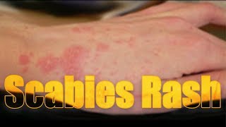 Scabies Rash itchy highly contagious skin disease  Usapang pangkalusugan [upl. by Lasyrc363]