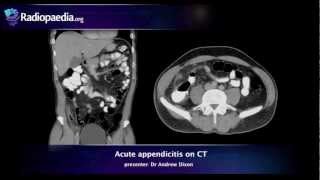 Acute appendicitis on CT  radiology video tutorial [upl. by Twila436]