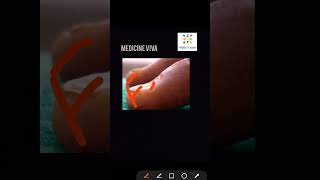 Medicine Koilonychia spoon nail iron deficiency anemia [upl. by Moir]