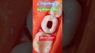 Angulation of files 🟣 Mesial amp Distal Canals 🟤 PULPECTOMY [upl. by Etnoled868]