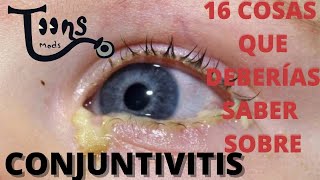 CONJUNTIVITIS16 COSAS QUE DEBERÍAS SABER bacterianadel recien nacidoviralsintomas y tratamiento [upl. by Iphigenia]