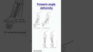 Forearm angle deformity  forearms deformity varus valgus gunshot orthopedics [upl. by Adlig]