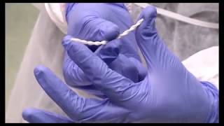 ARCHIMEDES Stent Placement  Humanitas Research Hospital [upl. by Shawna]