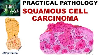 SQUAMOUS CELL CARCINOMA Clinical features amp Morphology Premalignant lesions [upl. by Jb170]