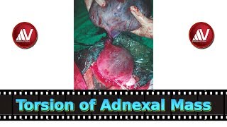 Adnexal Torsion Part I [upl. by Robert]