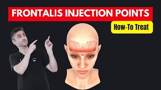 HowTo Treat The Frontalis With Botox  Dr Chris Hutton Aesthetics Training [upl. by Aronoff367]