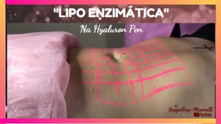 Lipo Enzimática com Hyaluron Pen [upl. by Xenophon]