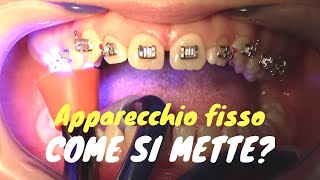 Come si mette lapparecchio fisso [upl. by Letnuhs339]