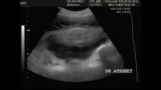 Ascite tuberculeuse Dr ACHIBET [upl. by Pond]