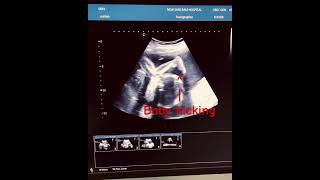 Baby Kicking in womb  fetal movement baby movement obglife ytshorts pregnancy [upl. by Herra]