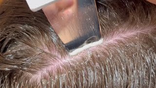 How to remove buildup from scalp scalp buildup or dandruff me difference kese kre shorts haircare [upl. by Fairleigh727]