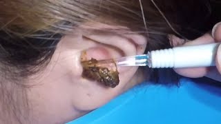 The Most Massive Earwax Removed in One Scoop [upl. by Wyck]