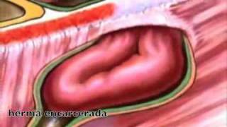 GASTROCIRURGIA  Vídeos  Hérnia Encarcerada [upl. by Lucais]