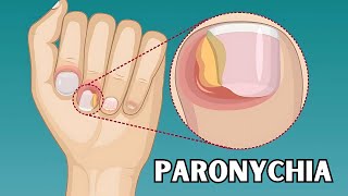 Paronychia  Causes Risk Factors Signs amp Symptoms Treatment  Everything You Need To Know [upl. by Kcirednek]