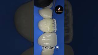 Dr Incisor Dentine layering dental dentist dentistry smile teeth dentalcare dentalclinic [upl. by Eniamzaj]