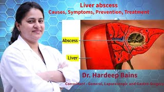 Liver abscess  लिवर एब्सेस रोग क्या है  यकृत फोड़ा  Dr Hardeep Bains [upl. by Frasier121]