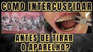 Como fazer a intercuspidação antes de remover o aparelho ortodôntico Aula 211 [upl. by Marice]