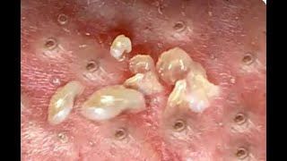 Shocking Cystic Blackheads amp Whiteheads Extraction Revealed  new blackheads this week 12301 [upl. by Pestana291]