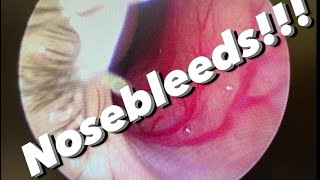 Nosebleeds epistaxis causes prevention treatments and more [upl. by Mich]