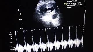 10 weeks pregnancy left Adnexal cystic Mass360P [upl. by Sage514]