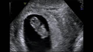 What Can You See At A 9 Week Baby Scan [upl. by Seni]