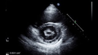 Mitral stenosis Quantifications Planimetry tips and tricks [upl. by Asset]