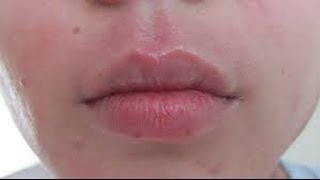 How to get rid of Perioral Dermatitis [upl. by Charlean]