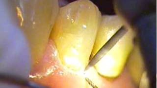 DR GERARD CUOMO  Cosmetic Dentistry  2 Mikes Case  Bonding  Boca Raton  Florida [upl. by Cher]