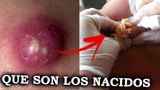 COMO CURAR NACIDOS🔴 EN LA PIEL O FORUNCULOS  REMEDIOS NATURALES🍃 CASEROS [upl. by Neirod]