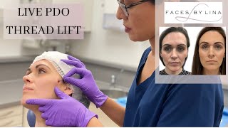 Watch the PDO Thread Lift in Action Say Goodbye to Nasolabial Folds and Marionette Lines [upl. by Anigue837]