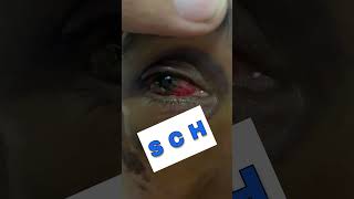 Subconjunctival Hemorrhage Part 4 Shorts SubconjunctivalHemorrhage [upl. by Waterman]