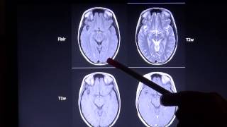 Grundlagen und Unterscheidungsmerkmale zu wichtigen MRT Sequenzen [upl. by Yllet420]