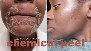 Chemical Peel for Dark Spots Acne amp Large Pores  Before amp After Results [upl. by Asaert]