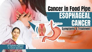 Treatment for Cancer in Food Pipe  ✅Esophageal Cancer Risk Factors Symptoms and Treatment in Hindi [upl. by Oiromed]