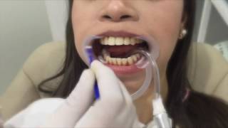 Nonperoxide Teeth Whitening [upl. by Anilrac]