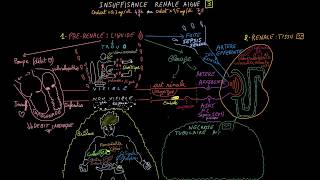 Insuffisance rénale aiguë  Docteur Synapse [upl. by Setiram]