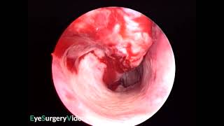 Inferior turbinate infracture [upl. by Ahteres]