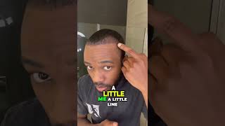 Achieve Healthy Hair Growth Tips and Updates on my Hair Transplant Journey [upl. by Callan]