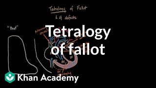 Tetralogy of fallot  Circulatory System and Disease  NCLEXRN  Khan Academy [upl. by Tootsie]